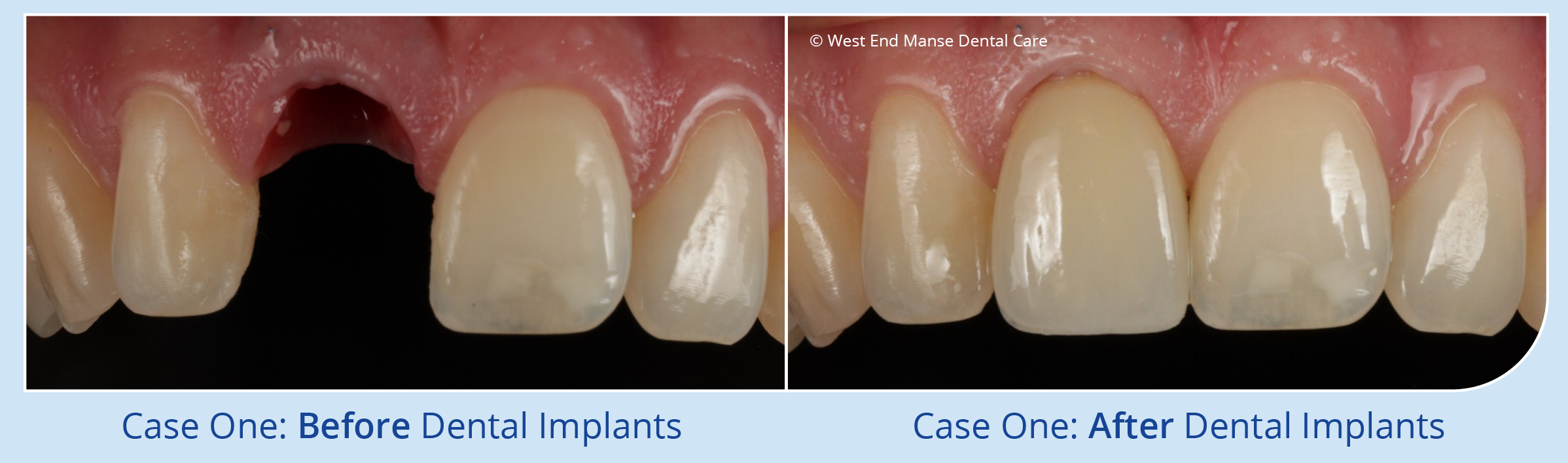 Dental Implants Haverhill